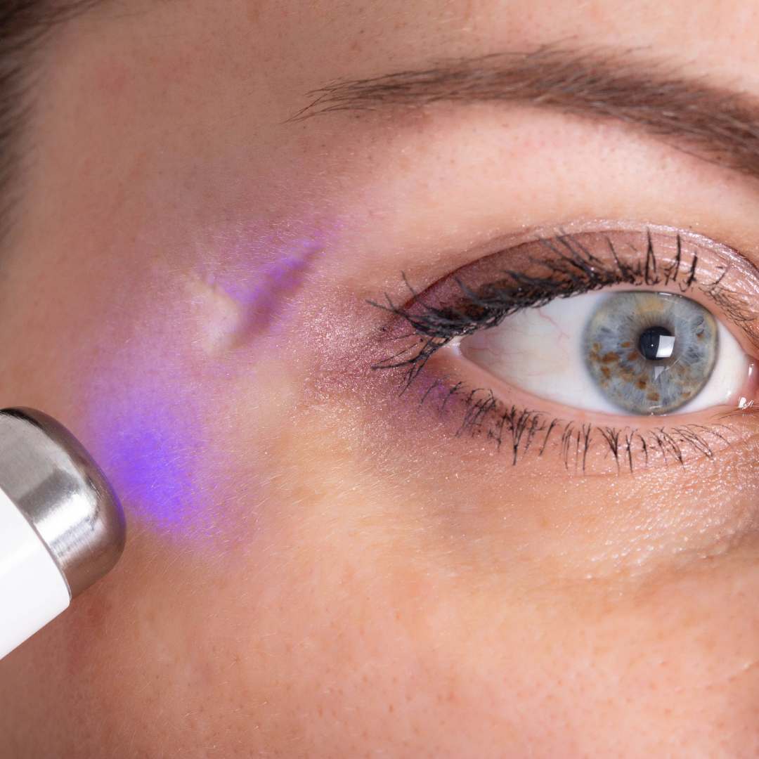 Essential Laser Resurfacing Aftercare Guide What You Should Avoid
